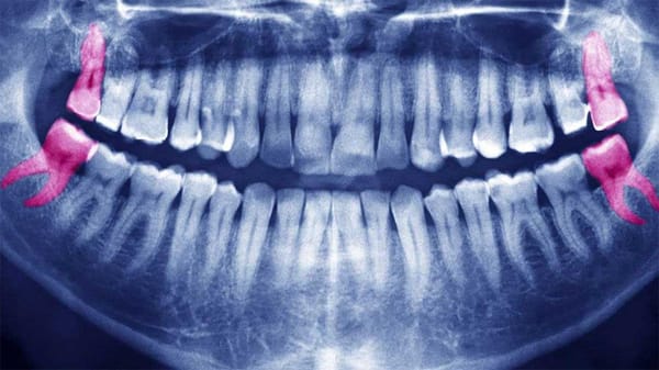 Editorial: What it's like to have your wisdom teeth removed